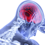 Le Malattie Neurodegenerative: Un Approfondimento su Alzheimer e Parkinson